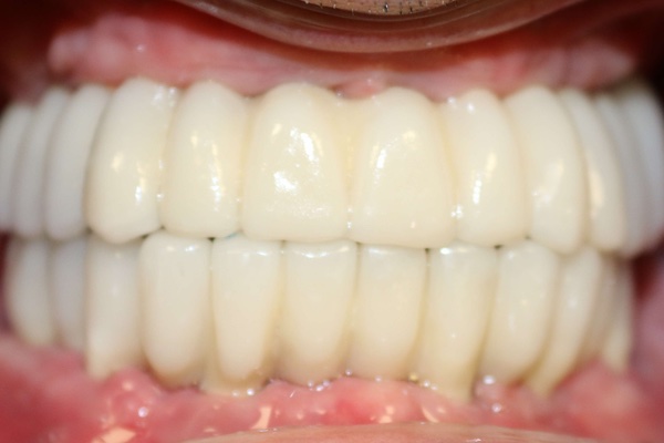 imagen de Caso implantes dentales ibarreta dental despues 1