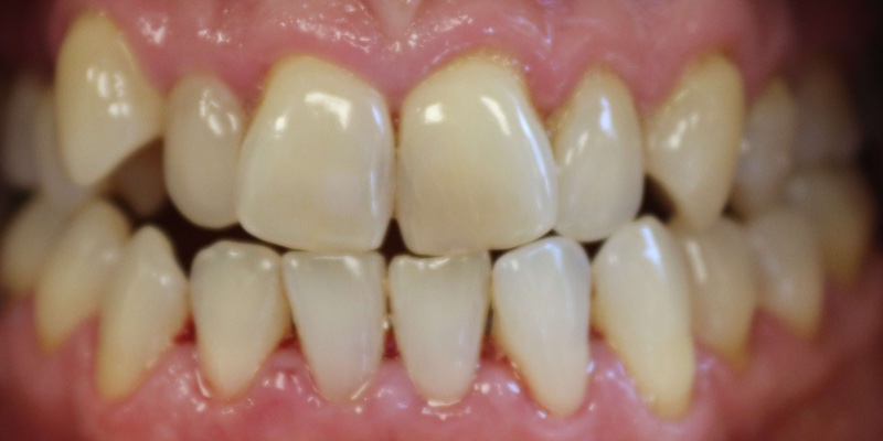 image of real case of invisible orthodontics ibarreta dental before 1