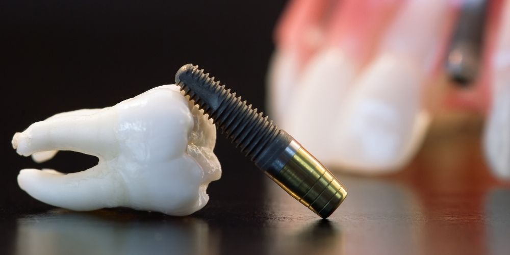 image des implants dentaires à Bilbao