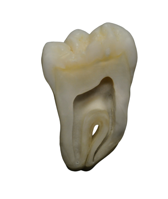 image d'un traitement endodontique à bilbao