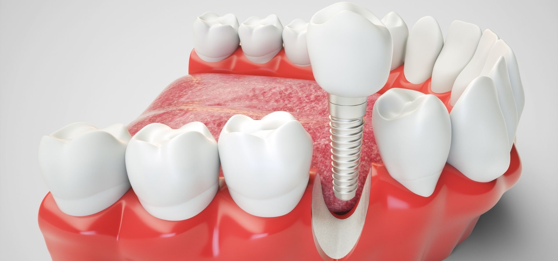 image de traitement d'implant dentaire à bilbao ibarreta dental