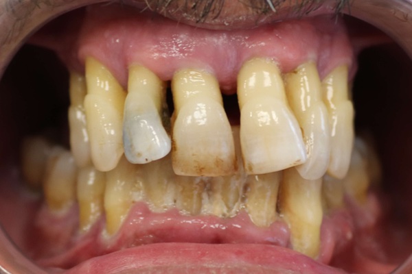 imagen de caso implantes dentales ibarreta dental antes 2