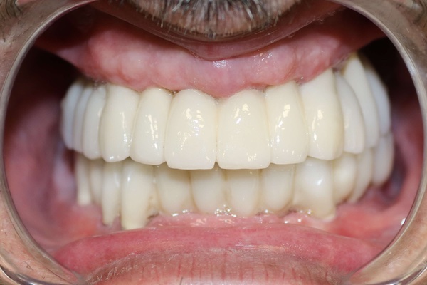 imagen de casos de implantes dentales ibarreta dental despues 2