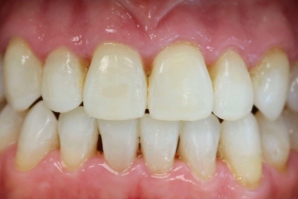 invisalign bilbao case image after 1